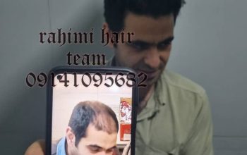 بهترین کلینیک کاشت مو در تبریز