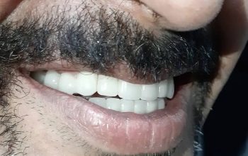 بهترین ایمپلنت معتبر با پرداخت اقساطی در کرج