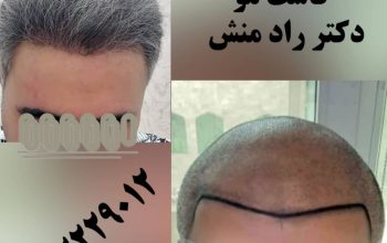 اولین مرکز کاشت مو در استان خوزستان