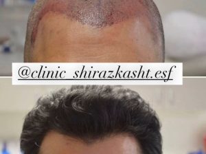 کاشت مو و ابرو با شرایط عالی و آموزش تخصصی